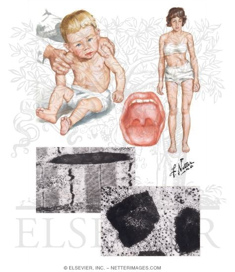 Nemaline Myopathy