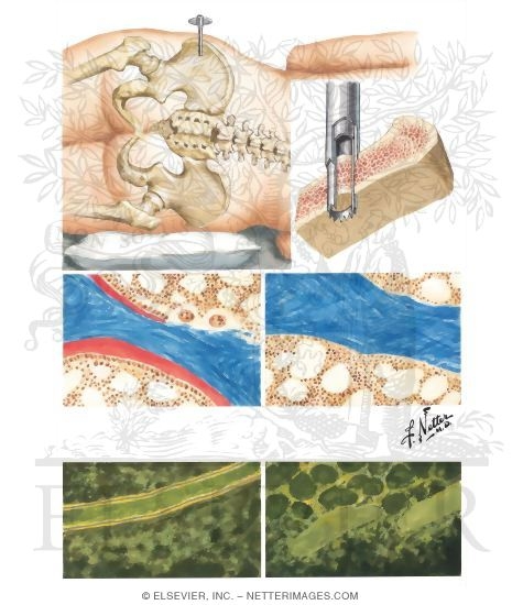 Watermarked preview of unlabeled image: Transiliac Bone Biopsy
