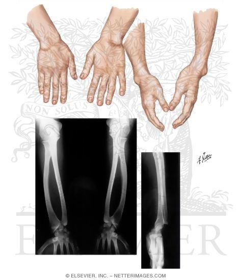 Watermarked preview of unlabeled image: Madelung's Deformity