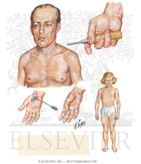 Myotonic Dystrophy