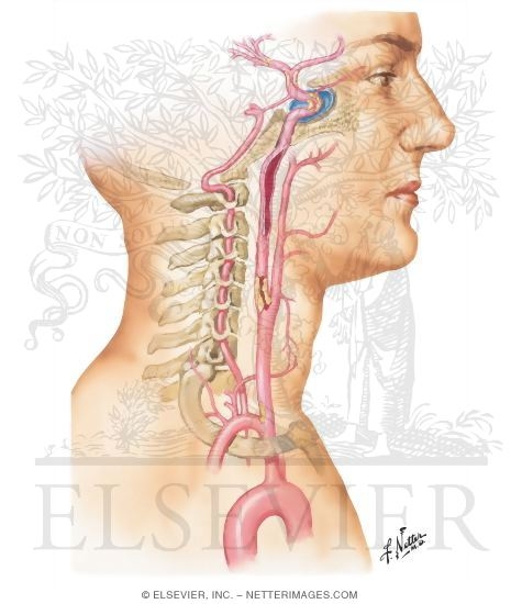 Stenosis or Occlusion of Carotid Artery