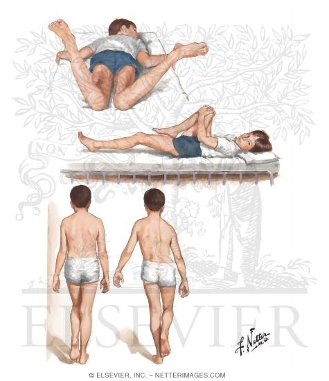 Physical Examination In Legg-Calve-Perthes Disease