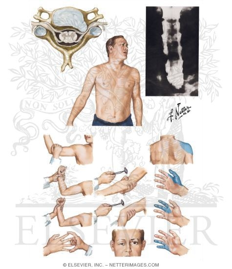 Cervical Disc Herniation: Clinical Manifestations