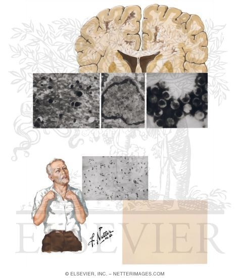 Slow Virus Infections