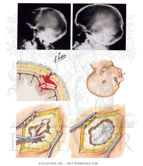 Watermarked preview of unlabeled image: Compound Depressed Skull Fractures