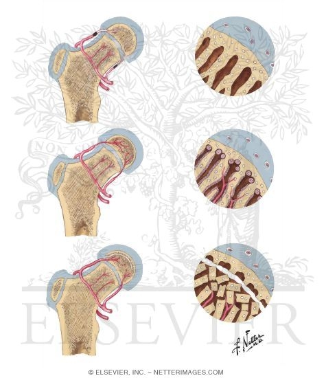 Pathogenesis of Legg - Calve - Perthes Disease