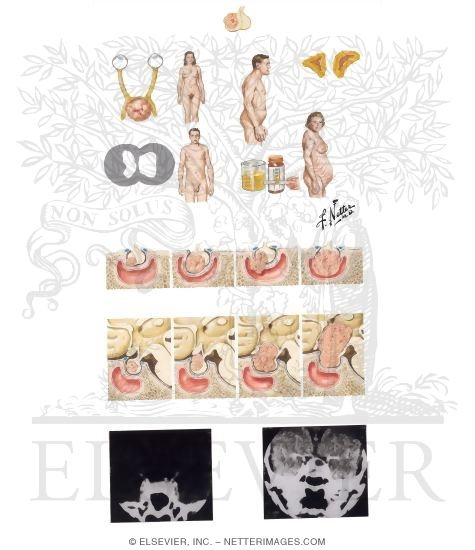 Watermarked preview of unlabeled image: Pituitary Tumors