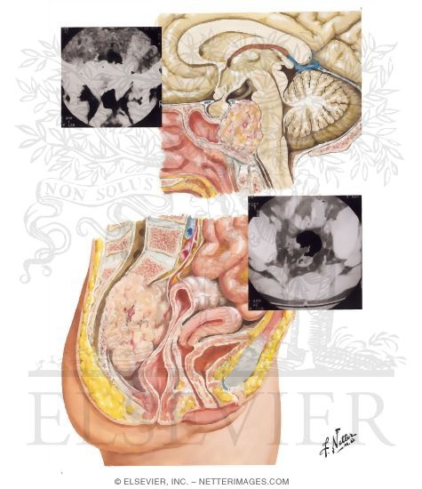Watermarked preview of unlabeled image: Chordomas