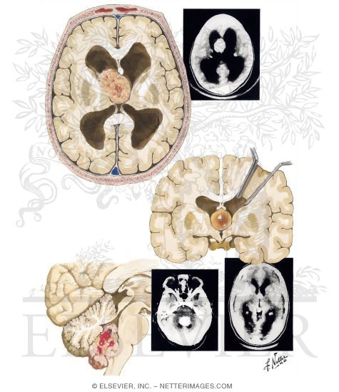 Intraventricular Tumors