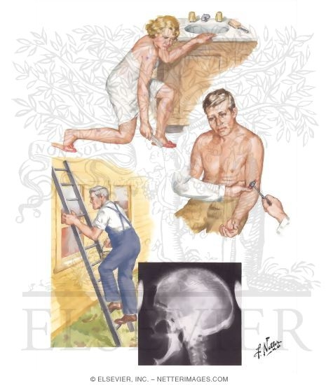 Watermarked preview of unlabeled image: Myopathies Secondary to Endocrine Disorders