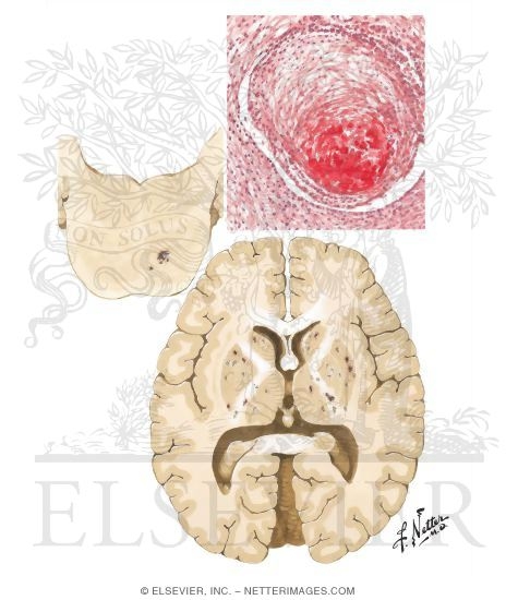 Lacunar Infarction