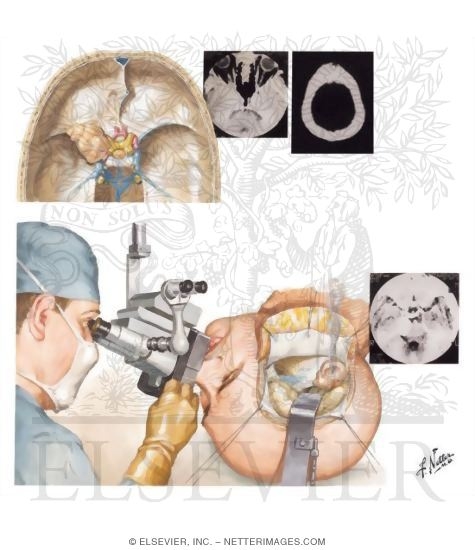 Meningiomas