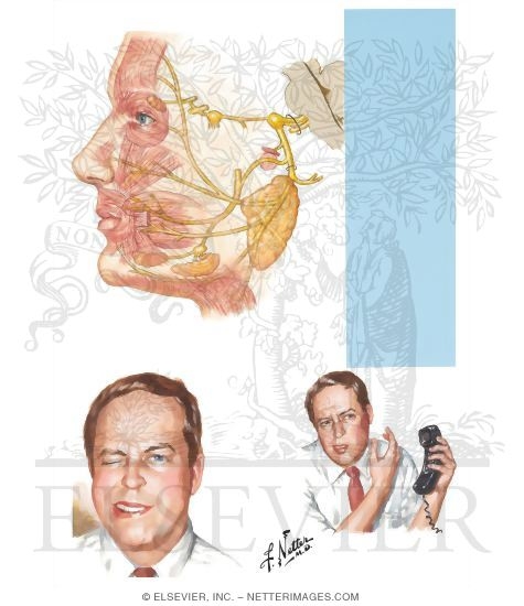 Watermarked preview of unlabeled image: Bell's Palsy
