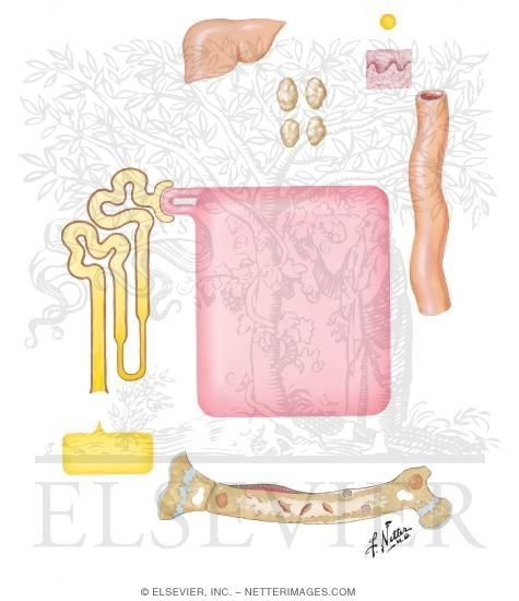 Vitamin D-Dependent (Pseudodeficiency) Rickets and Osteomalacia