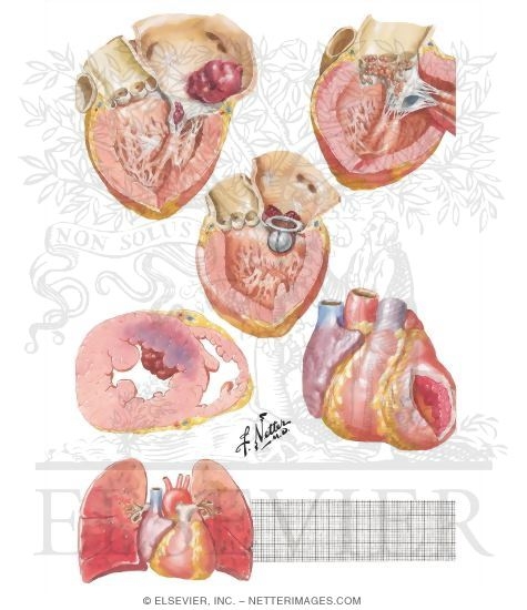 Watermarked preview of unlabeled image: Cardiac Sources of Cerebral Emboli