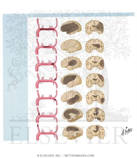 Occlusion of Middle and Anterior Cerebral Arteries