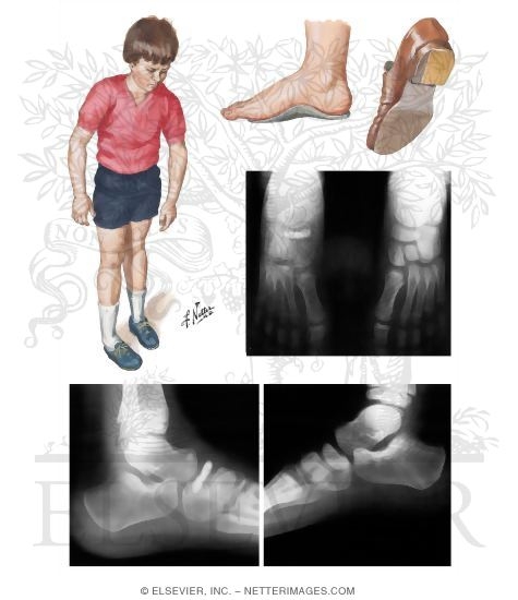 Kohler's Disease I