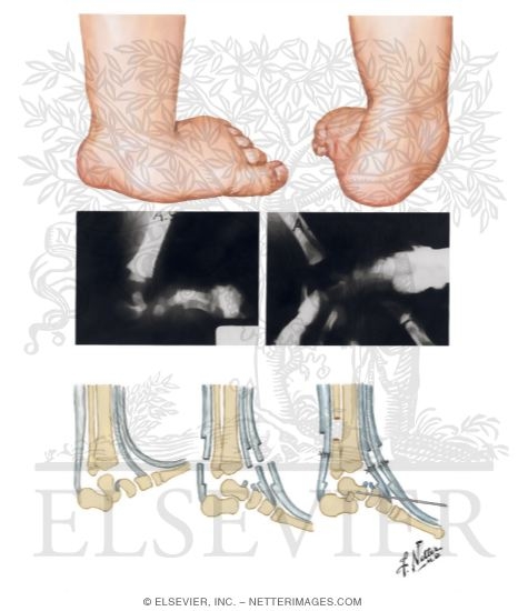 Congenital Vertical Talus