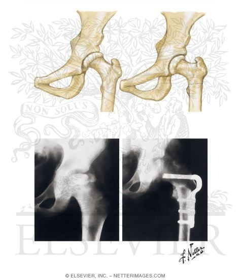 Femoral Varus Derotational Osteotomy