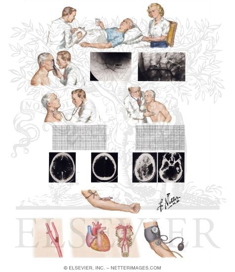 Watermarked preview of unlabeled image: Clinical Evaluation and Therapeutic Options in Stroke