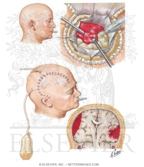 Acute Subdural Hematoma