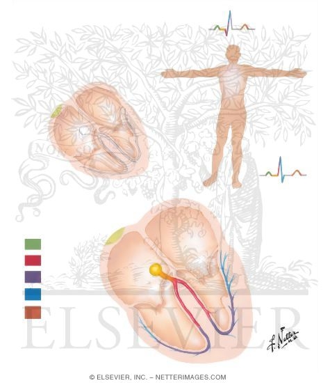Normal Sequence of Cardiac Depolarization and Repolarization and Derivation of ECG