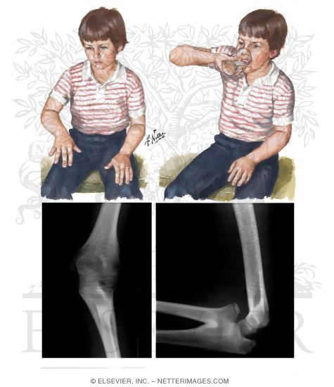 Watermarked preview of unlabeled image: Congenital Radioulnar Synostosis