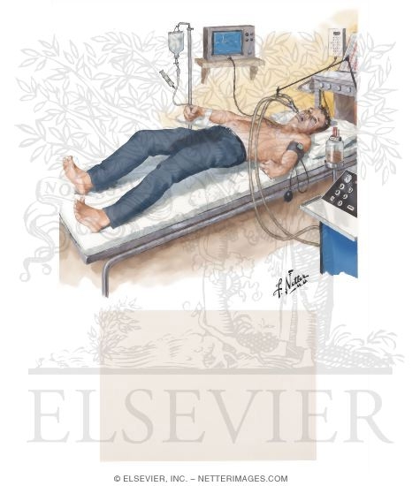 Status Epilepticus