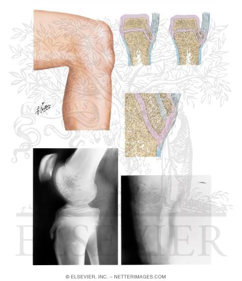 Watermarked preview of unlabeled image: Osgood-Schlatter Lesion