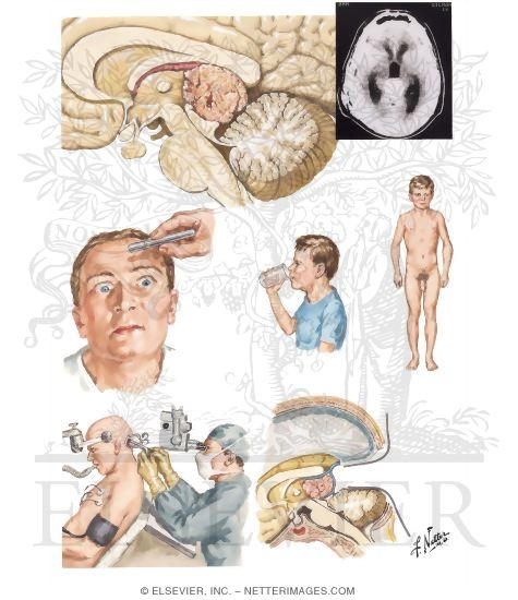 Watermarked preview of unlabeled image: Tumors of Pineal Region