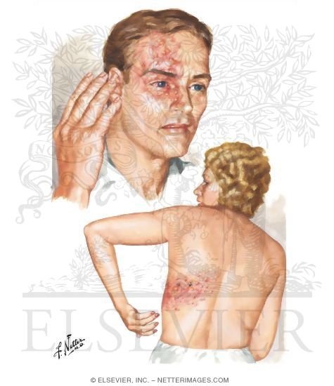 Watermarked preview of unlabeled image: Herpes Zoster