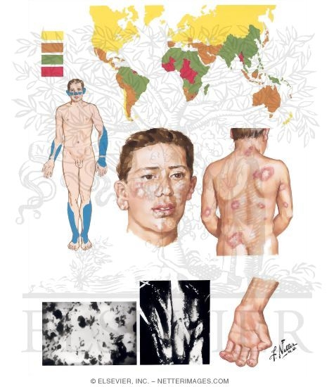 Leprosy