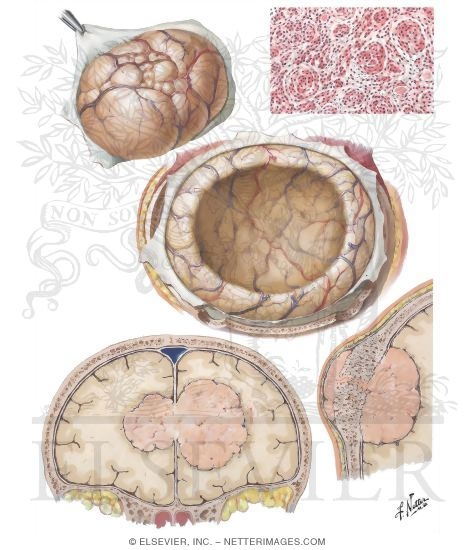 Meningiomata