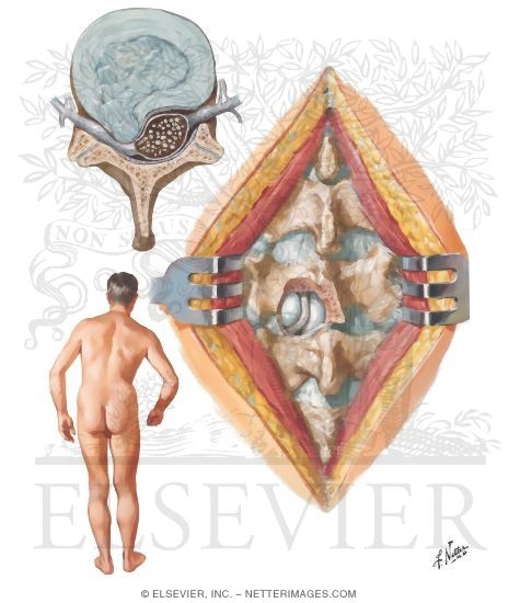 Herniation of Lumbar Intervertebral Discs