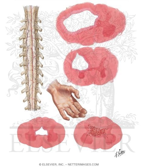 Watermarked preview of unlabeled image: Syringomyelia, Hematomyelia and Hydromyelia