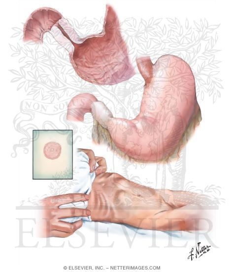 Hypertrophic Pyloric Stenosis
