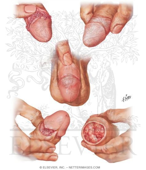 Watermarked preview of unlabeled image: Warts, Precancerous Lesions, Early Cancer