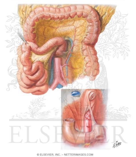 Duodenal Fossae and Ligament of Treitz