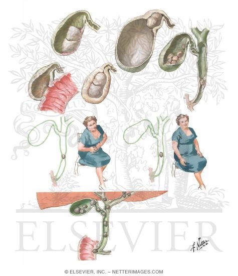 Watermarked preview of unlabeled image: Cholelithiasis II - Clinical Aspects