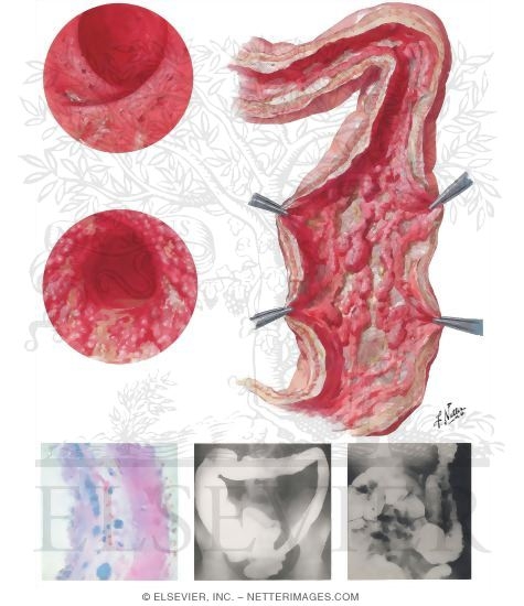 Ulcerative Colitis