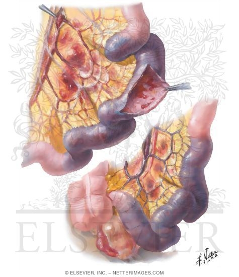 Watermarked preview of unlabeled image: Mesenteric Vascular Occlusion