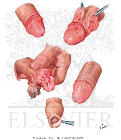Balanitis