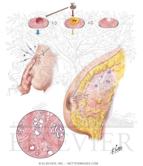Chronic Cystic Mastitis I - Mastodynia