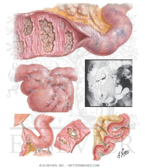 Intestinal Tuberculosis