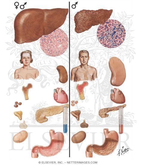 Hemosiderosis, Hemochromatosis: Normal Iron Metabolism
