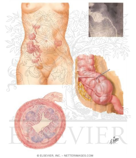 (Vermiform) Appendix 
Appendix Vermiformis
