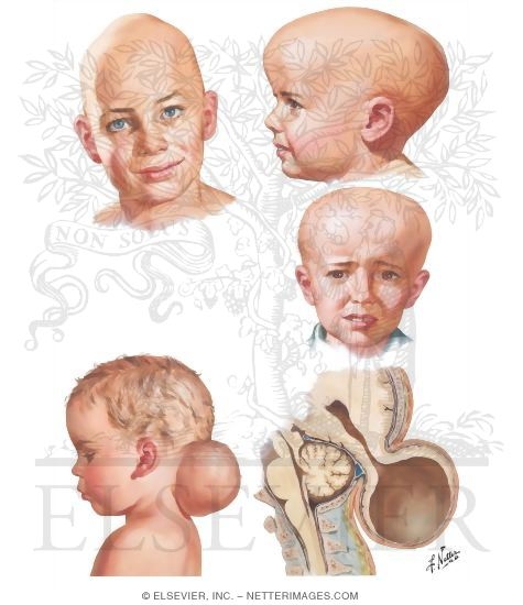 Craniosynostoses and Encephalocele