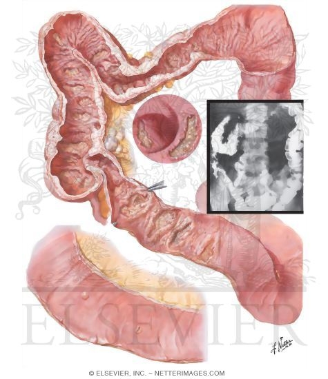 Watermarked preview of unlabeled image: Intestinal Tuberculosis, Appearance of Mucosa