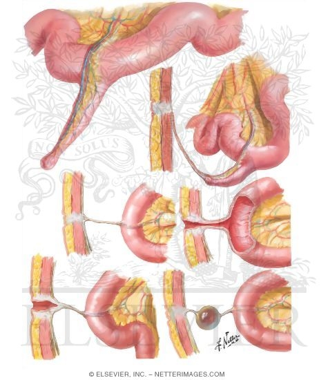 Meckel's Diverticulum - Vitelline Duct Remnants