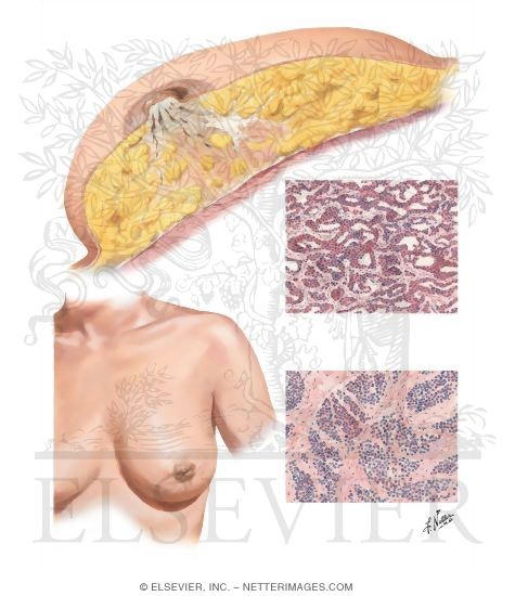 Infiltrating Carcinoma (Scirrhus)